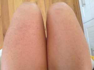 After using SolarCare B3 on one leg for 3 months