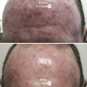 Before and after, sun-damaged skin